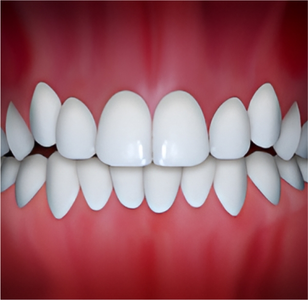 By Orthodontic Treatment, Crowding Teeth problem can be solved at Kalaskey Orthodontics