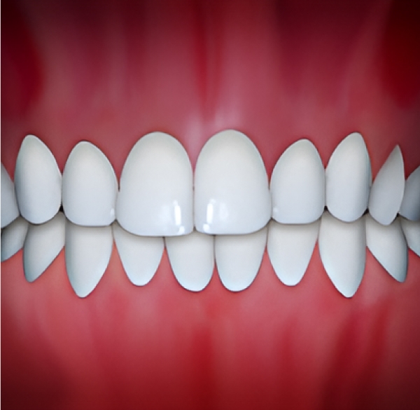 Dental Midlines are off and that can be treated by Orthodontic Treatment at Kalaskey Orthodontics