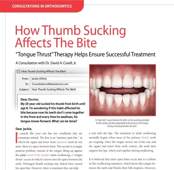 How Thumb Sucking Affects The Bite Article At Kalaskey Orthodontics Charleston West Virginia