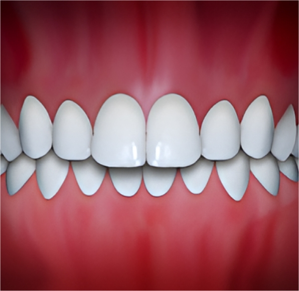Overbite Teeth Problem can be solved by doing Orthodontic Treatment at Kalaskey Orthodontics