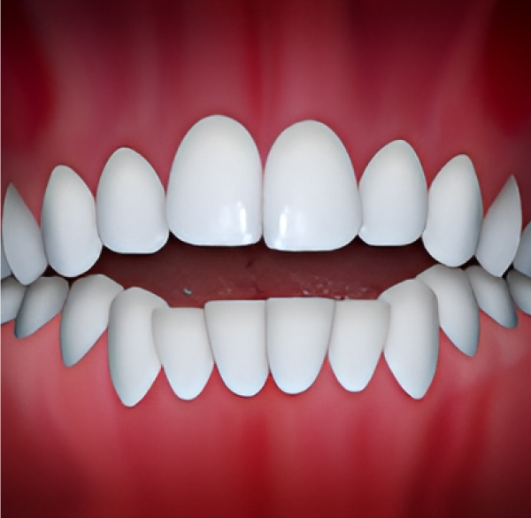 Thumb Sucking or Pacifier Use creates an Open Bite which can be treated with orthodontic treatment at Kalaskey Orthodontics
