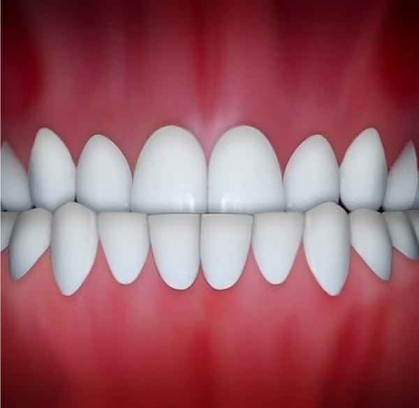 Underbite Teeth can be treated using ordinary Orthodontic method at Kalaskey Orthodontics