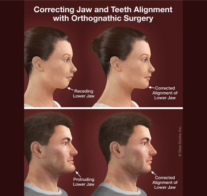 Orthognathic Surgery Available at Charleston West Virginia