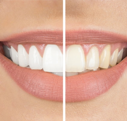 Representation Of Teeth Before And After Whitening at Charleston West Virginia