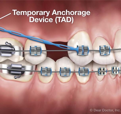 Visual Representation Of Braces at Charleston West Virginia